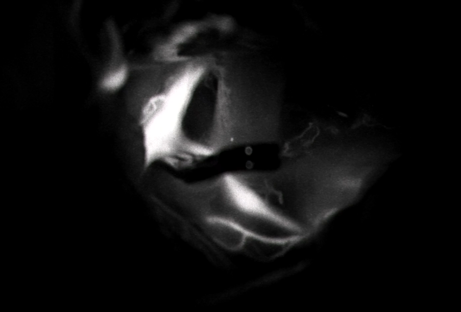 Figure 9. Final clip application at the aneurysm neck.]